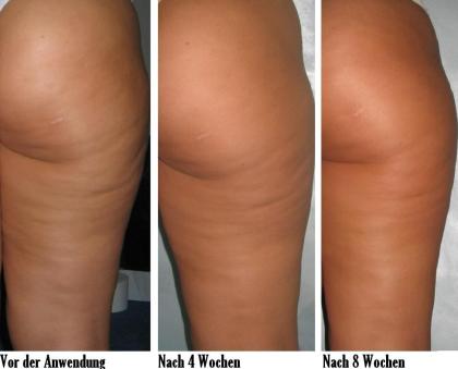 CELLULITE SCHLAFFE HAUT