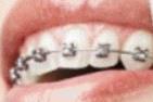 Professionell Zahnreinigung bei Spange oder Implantat