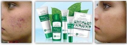 Natürliche Lösung gegen Mitesser Pickeln und Narben - Master Herb Antiakne vom