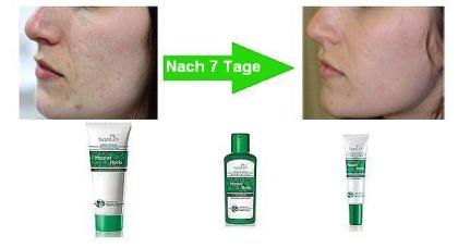 Serie gegen Akne Natur-Kosmetik - effektiv gegen Pickeln Mitesser und Narben