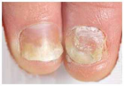 Nagelpilz effektiv bekämpfen aus Asien